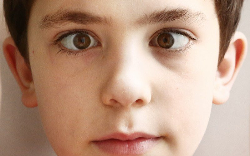 Mata Juling (Strabismus)